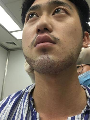 海南煌越植发医疗美容门诊部收费价格表