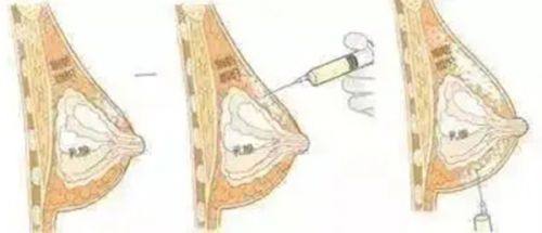 叶进医生擅长项目