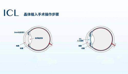松原润明眼科医院特色项目及技术优势