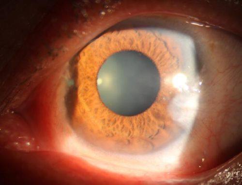 西安阿玛施眼科医院特色项目及技术优势