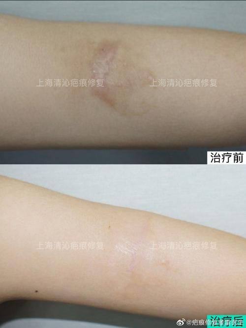 宣城仁爱医院整形烧伤外科真人口碑评价