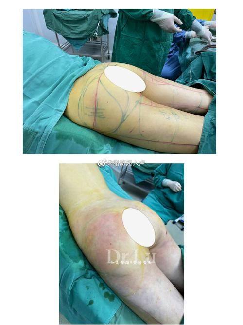 韩国芭比莱茵整形医院是正规医院吗？