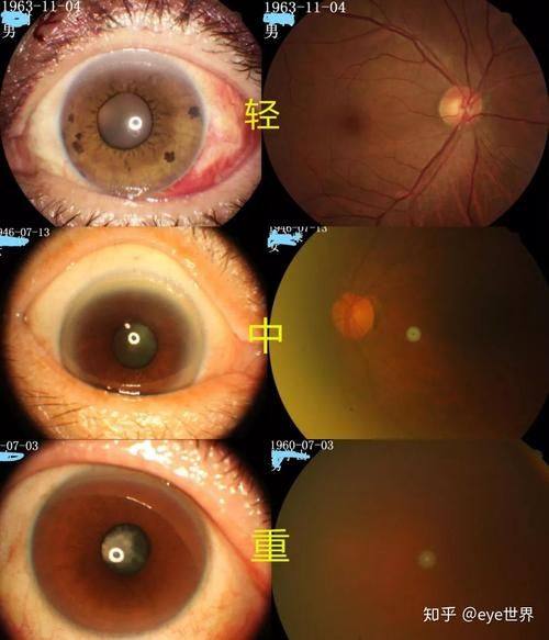 福州华厦眼科医院真人口碑评价怎么样？