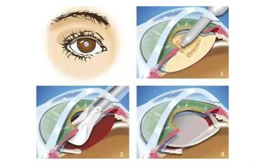 肃宁建勋眼科诊所特色项目及技术优势