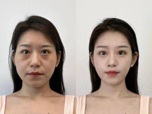 韩国Armline整形外科真人口碑评价怎么样？