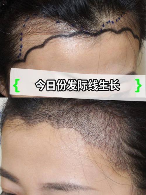 上海碧莲盛植发收费价格表/收费标准